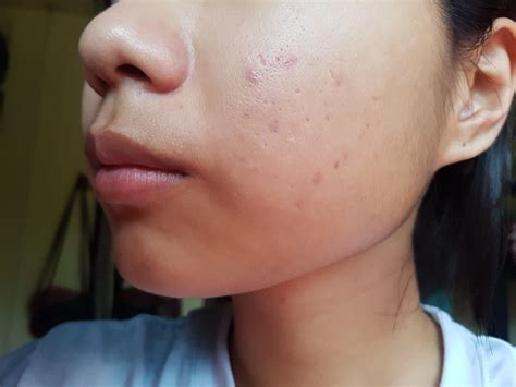 Will acne scars fade over time? How can I remove them? I also have them ...