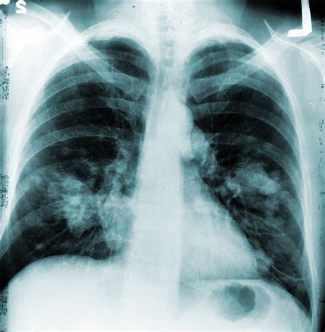 Chest X-ray Nodules Lung cancer chest ray rays deaths nih annual cut