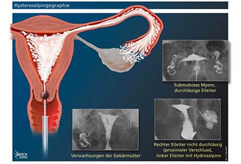 Fallopian tube diagnostics – Kinderwunschteam Berlin