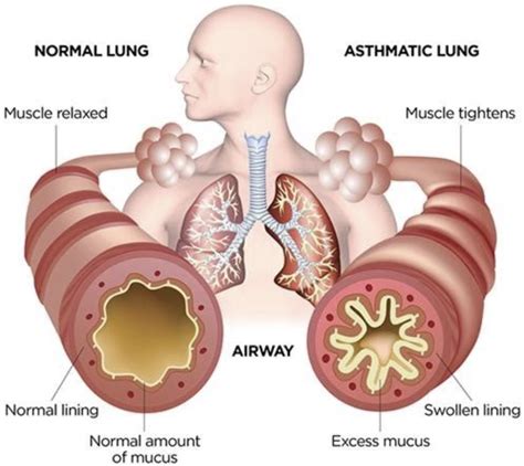 Asthma Attack Symptoms & First Aid