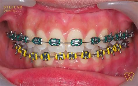 Braces Colors: Top Picks For 2023 - Stellar Dental