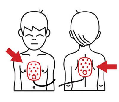 Philips HeartStart OnSite Child Pad Placement Guide - 989803139281 ...