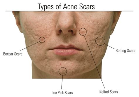 Acne Scars: Types of Acne Scarring and Ideal Treatments