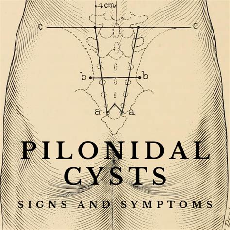 Painful Bump on Your Tailbone? Symptoms of a Pilonidal Cyst - YouMeMindBody