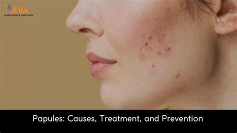 Papules: Causes, Treatment, and Prevention | EVA