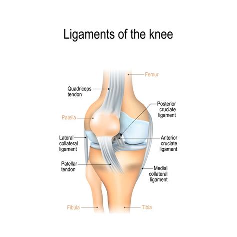 Posterior Cruciate Ligament (PCL) Injuries - Manaaki Healthcare