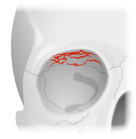 Orbital Fractures | Concise Medical Knowledge