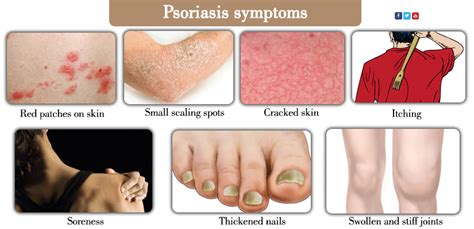 Herbal Remedies for Psoriasis - Dr Vikram Chauhan