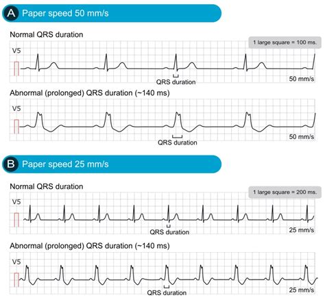 Killer ECG Patterns: Part • LITFL • ECG Library, 52% OFF