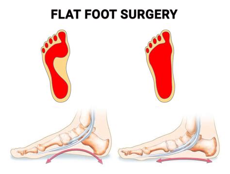 Flat Foot Surgery - Premier Podiatry: Velimir Petkov, DPM: Podiatrists ...