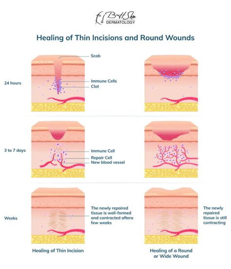 Wart Removal Recovery & Aftercare (Healing Time & Process)