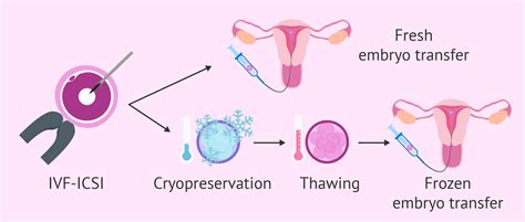 Fresh vs. frozen embryo transfer