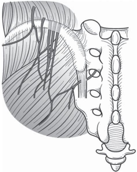 Superior Cluneal Nerves - Clinical Tree