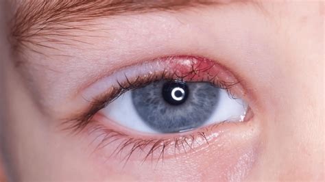 What Is An Eye Stye? Causes, symptoms, and Treatment