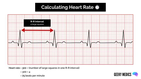 Heart ecg interpretation