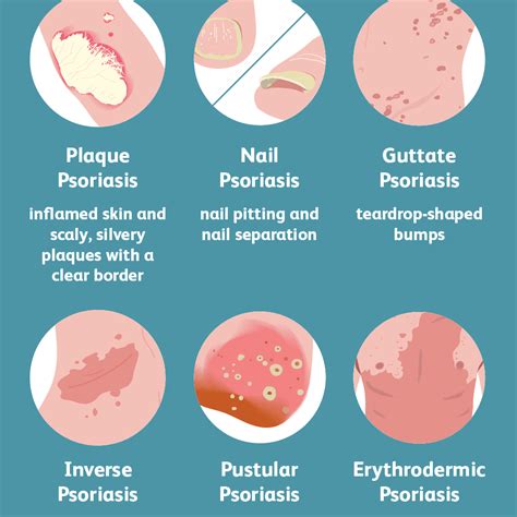 Psoriasis: Symptoms and Complications