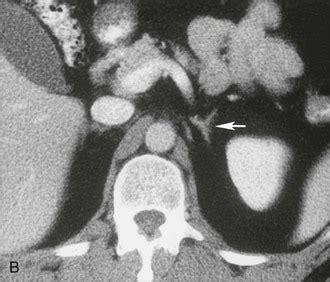 Adrenal Gland Imaging | Clinical Gate