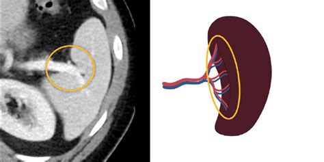 Abdominal CT: spleen and adrenal glands • LITFL • Radiology