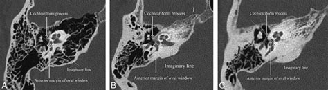 Qualitative description of the otic capsule contour relative to an ...