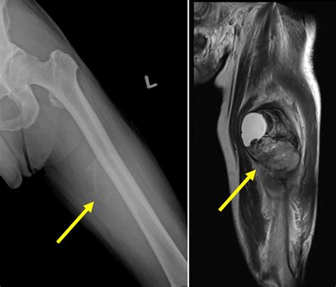 Extraskeletal osteosarcoma – Radiology Cases