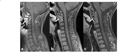 MRI of cervical spine (patient #8)(T1 TSE FS sagittal with a contrast ...