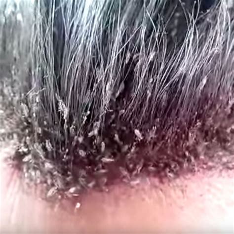 Girl, 9, dies after mother applied pesticide on her lice-infested hair ...