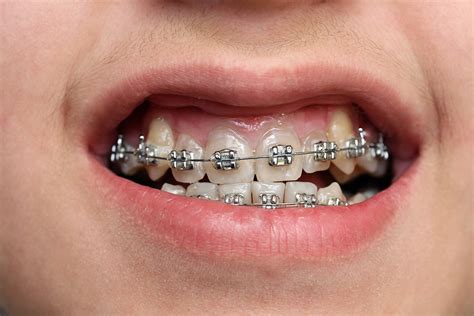 Free Dental Braces? Can My Child Get Them? - Ridgway Dental | Wimbledon ...