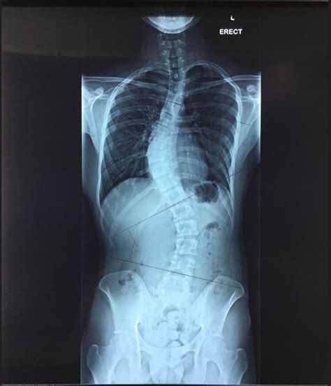 Lumbar Scoliosis X Ray