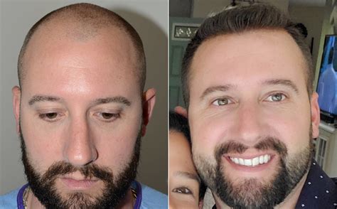 Hair Transplants for Men photos | Miami, FL | Patient117285