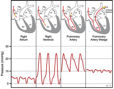 CV Physiology | Pulmonary Capillary Wedge Pressure