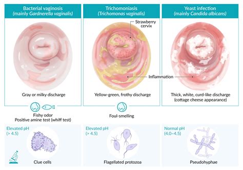 Bacterial Vaginal Infection