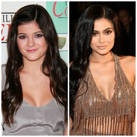 Kylie Jenner Before and After Plastic Surgery Photos Reveal Drastic ...