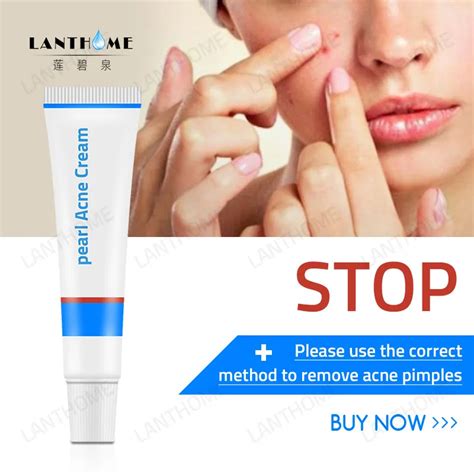 Pearl Acne Cream Anti Pimple Marks Removal Cream Face Care Spots Acne ...