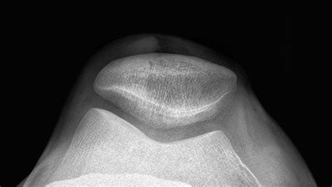 Patella (Knee Cap) Dislocation