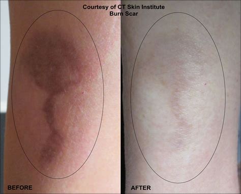 Burn Scar Laser Treatment - Connecticut Skin Institute