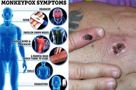 The 8 symptoms of monkeypox you need to know