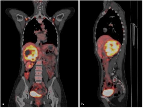 PET-CT scan: Tumor of the right adrenal gland with intense FDG-uptake ...