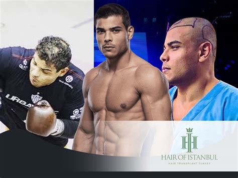 Fighter to Fashion Icon: Paulo Costa's Hair Transplant