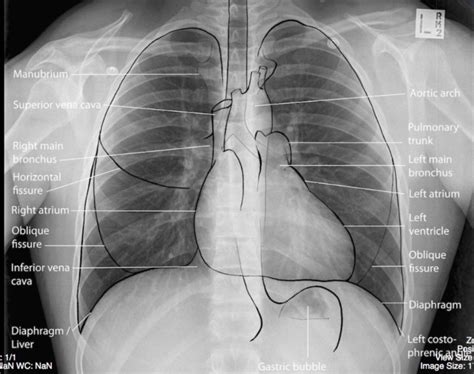 Normal, Labelled, Chest x-ray – Undergraduate Diagnostic Imaging ...