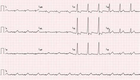 Asymptomatic Wolff-Parkinson-White Syndrome: Incidental EKG - JETem