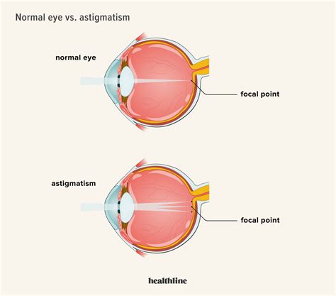 Astigmatism: Causes, Types, Symptoms & Treatment