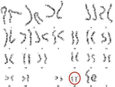 DiGeorge syndrome (22q11.2 deletion syndrome) - The Oncofertility ...