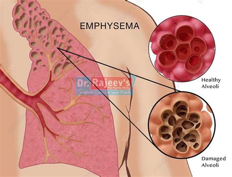 homeopathic treatment for Emphysema in homeopathy, Emphysema Treatment ...