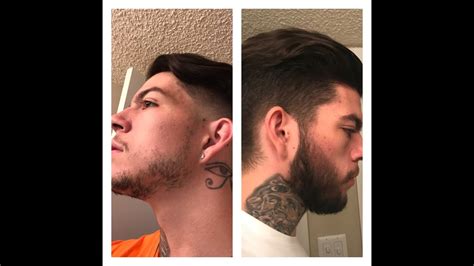 Minoxidil Beard Growth