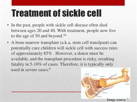 Sickle cell anemia