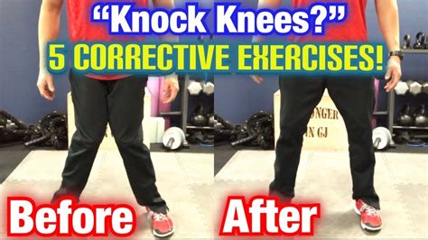 "Knock Knees" *Genu Valgum* 5 BEST CORRECTIVE EXERCISES! | Dr Wil & Dr ...