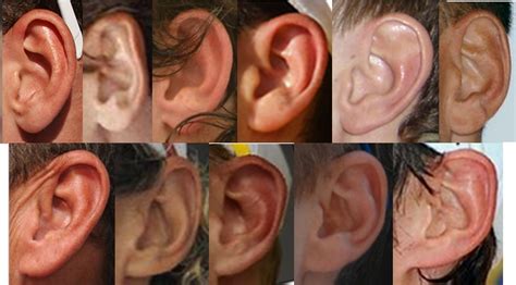 Myths of Human Genetics: Earlobes