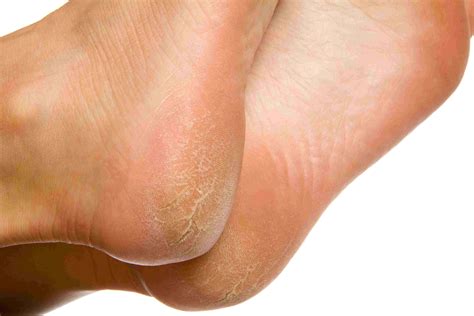 Can You Recognize Plantar Warts on Feet?