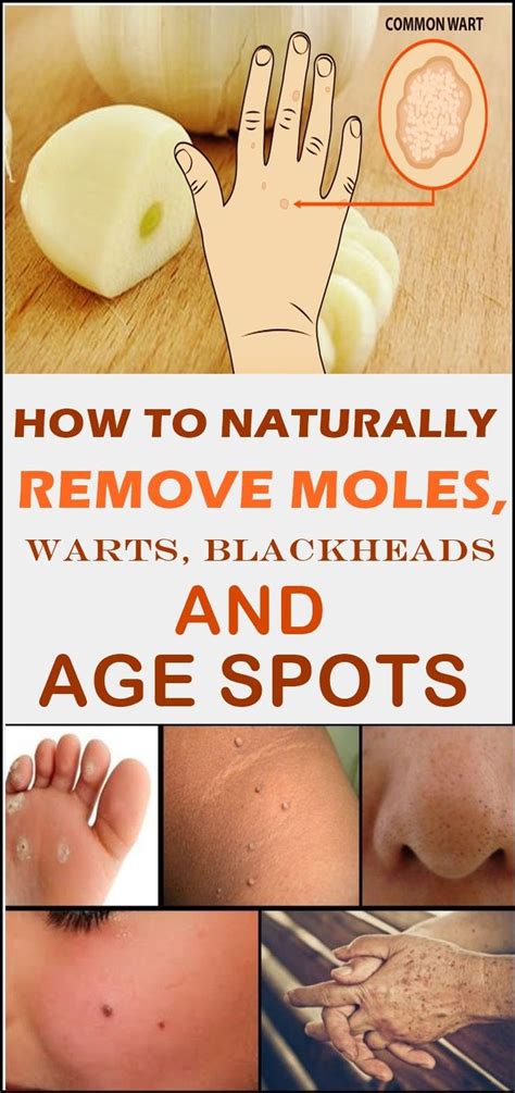 HOW TO NATURALLY REMOVE MOLES, WARTS, BLACKHEADS AND AGE SPOTS # ...