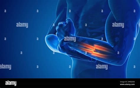 Broken hand bone pain medical concept Stock Photo - Alamy